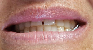 bagnell dental before